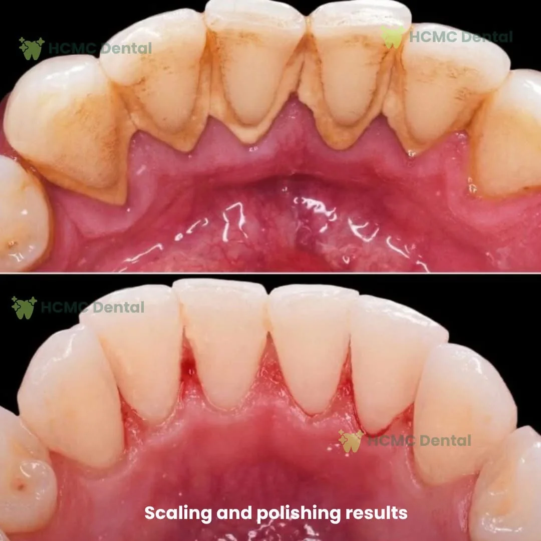 Lingual Calculus Debridement & Clean Enamel Finish - HCMC Dental Clinic Dr. Cuong