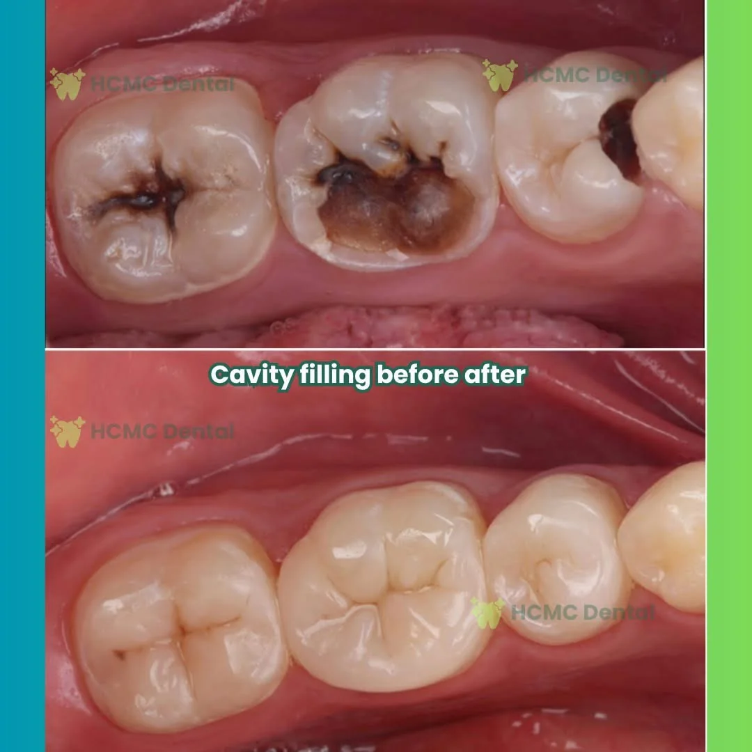 Molar Tooth Decay Aesthetic Composite Filling Dr Cuong HCMC