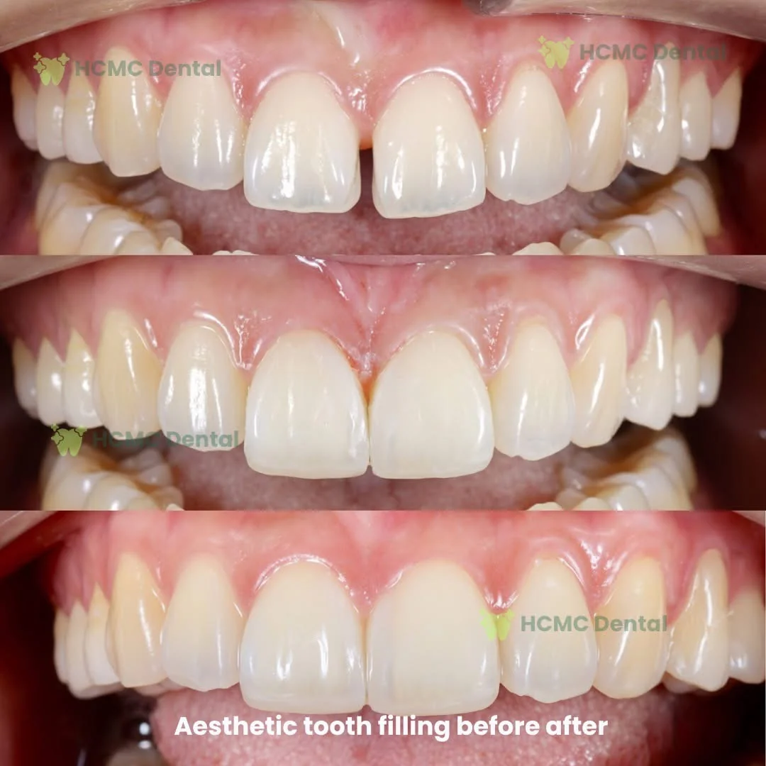 IPS e.max Veneer & Aesthetic Composite Smile Makeover - HCMC Dental Clinic Dr. Cuong