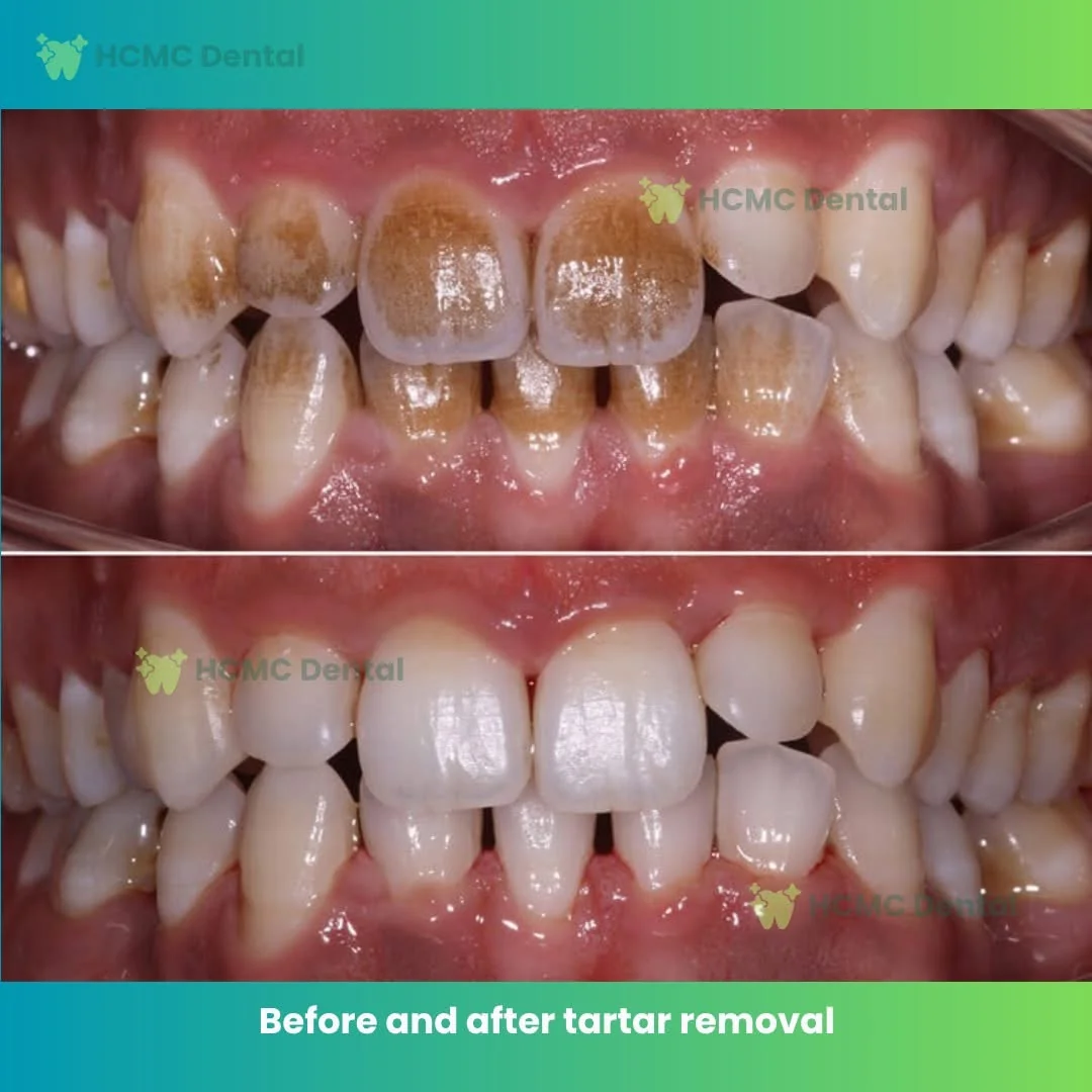 Stain Plaque Removal Airflow Polishing Saigon Vietnam